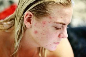 Reasons of pimples on face