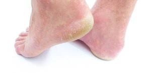 Types of fungal infection 